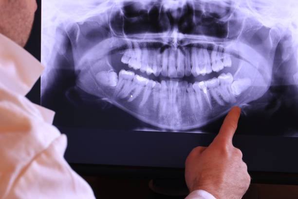 Best Dentist for Tooth Abscess  in Spearville, KS