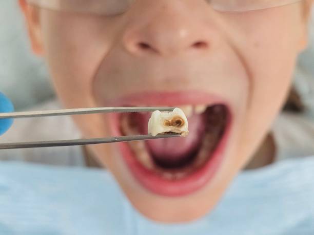 Best Emergency Tooth Extraction  in Spearville, KS